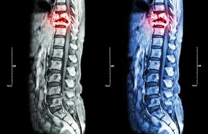 The Long-Term Effects of Spinal Cord Injuries