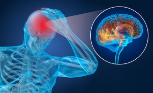 A New Type of Therapy May Help Victims of Concussion